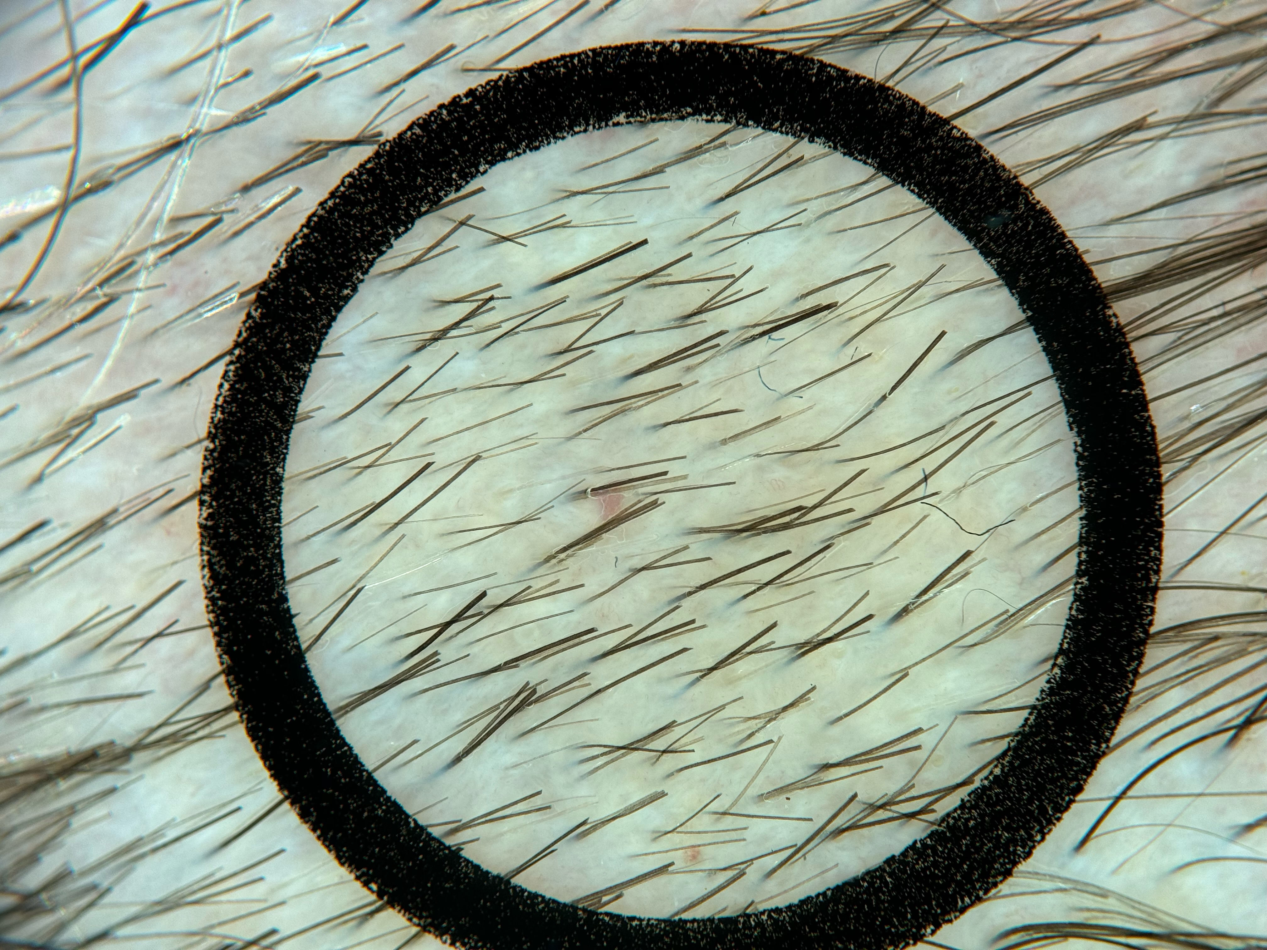 Sample image 1 for TrichoScan analysis, captured with Heine Delta 30