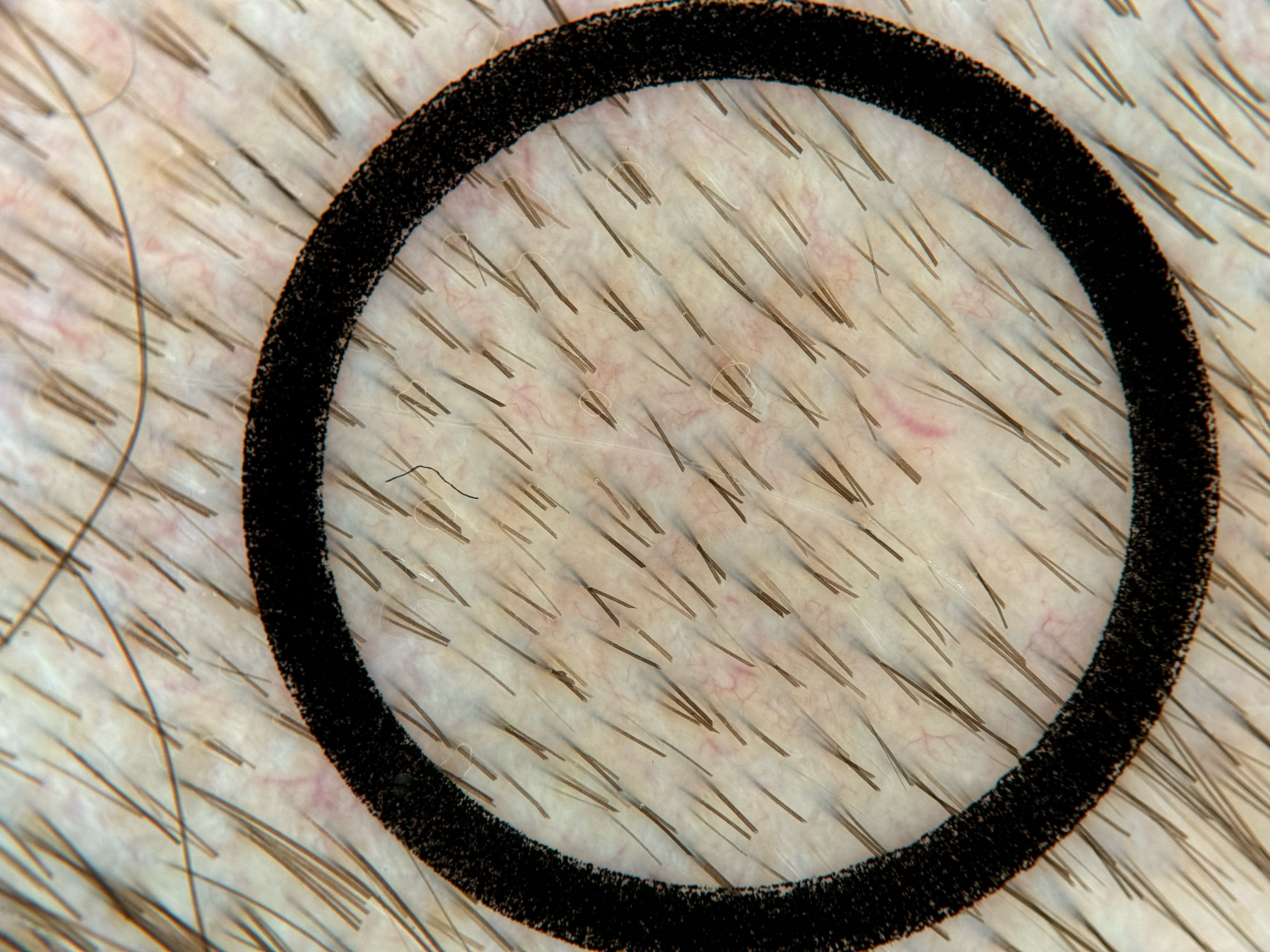 Sample image 3 for TrichoScan analysis, captured with Heine Delta 30