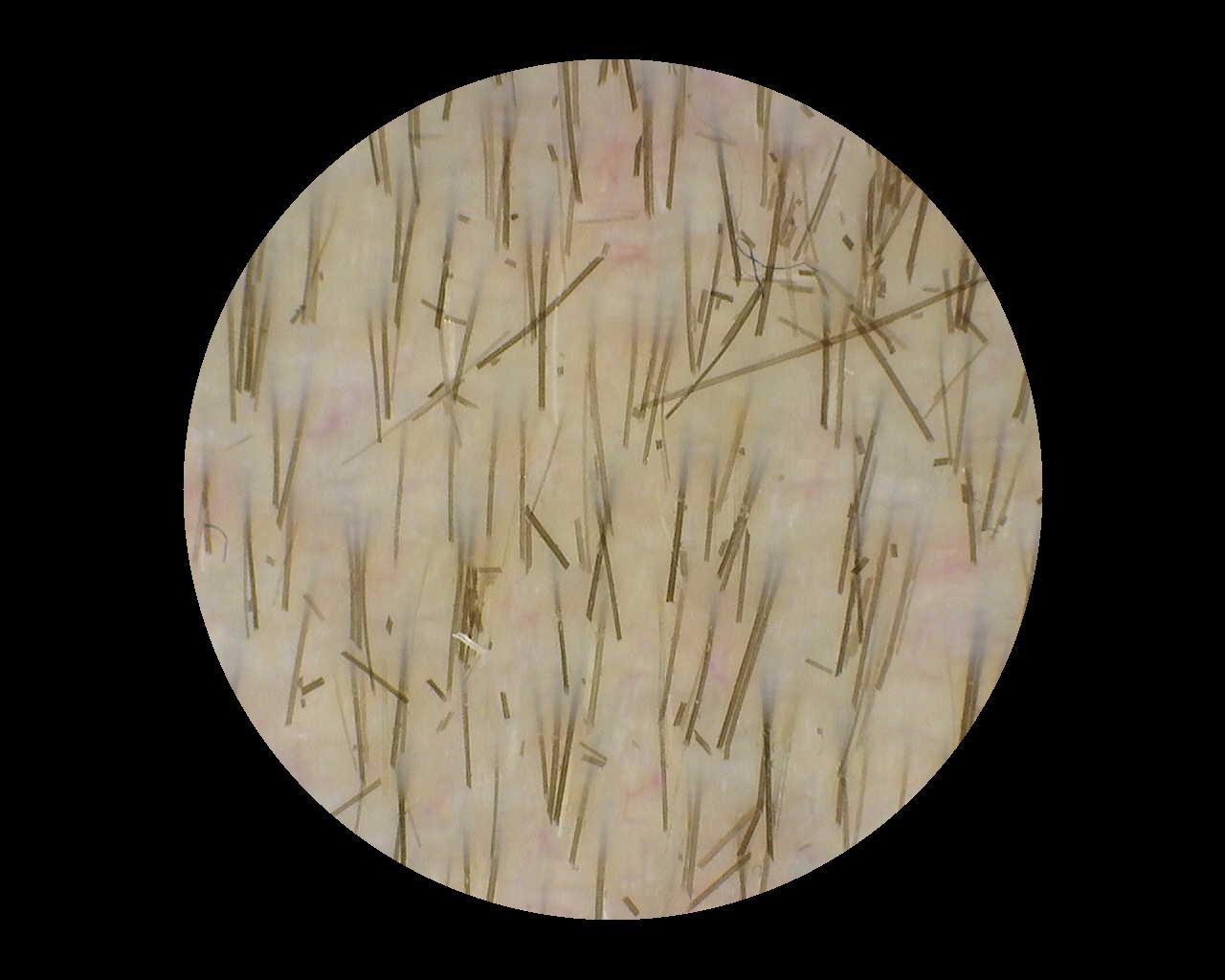 Unsuitable sample image: interfering hair residue and hairs running across the image