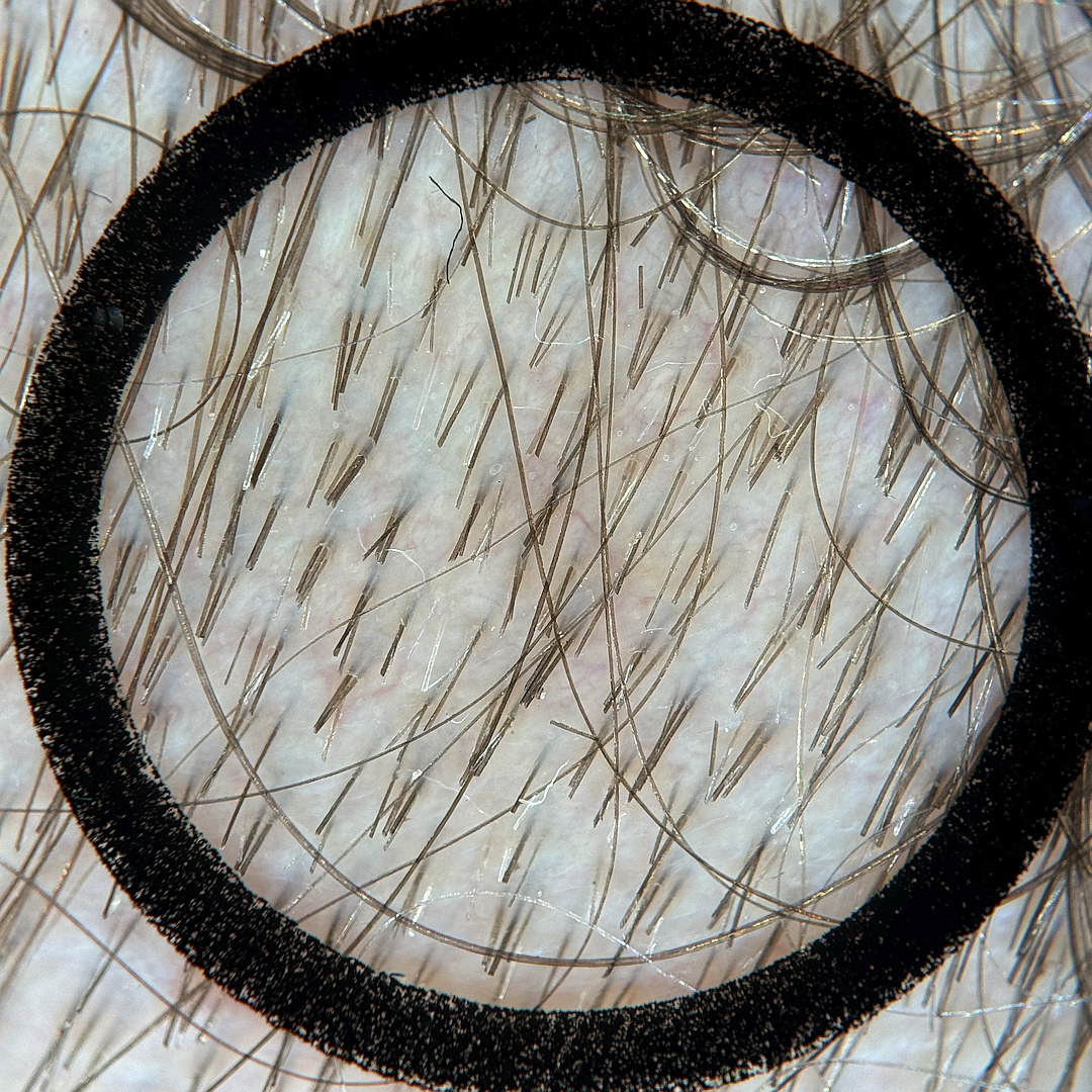 Unsuitable sample image: untrimmed hairs run across the image