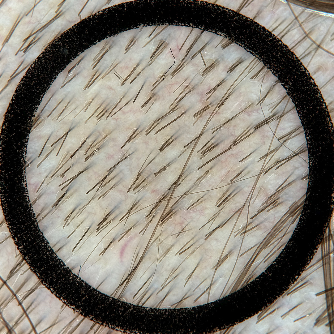 Unsuitable sample image: untrimmed hairs run across the image