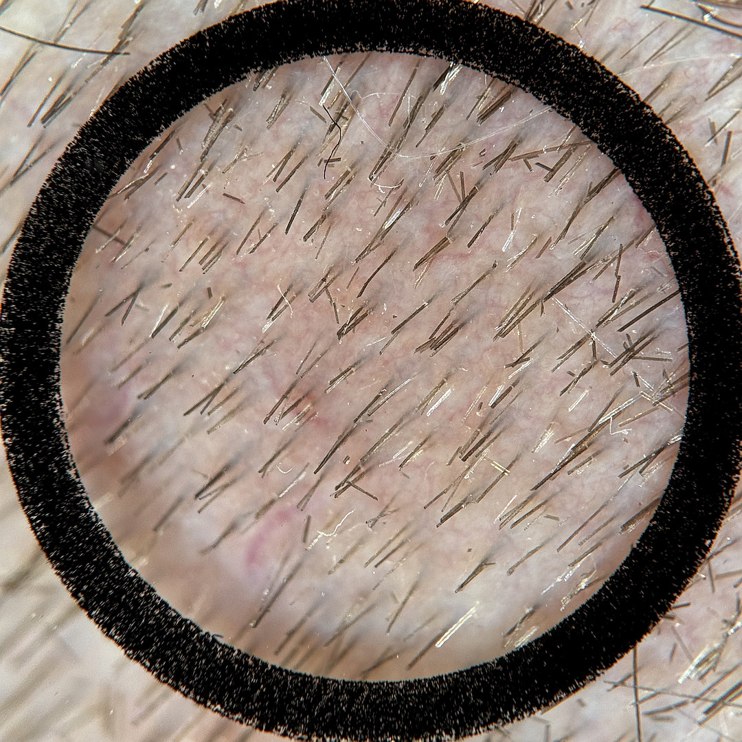 Unsuitable sample image: dermatoscope placed at an angle and interfering hair residue